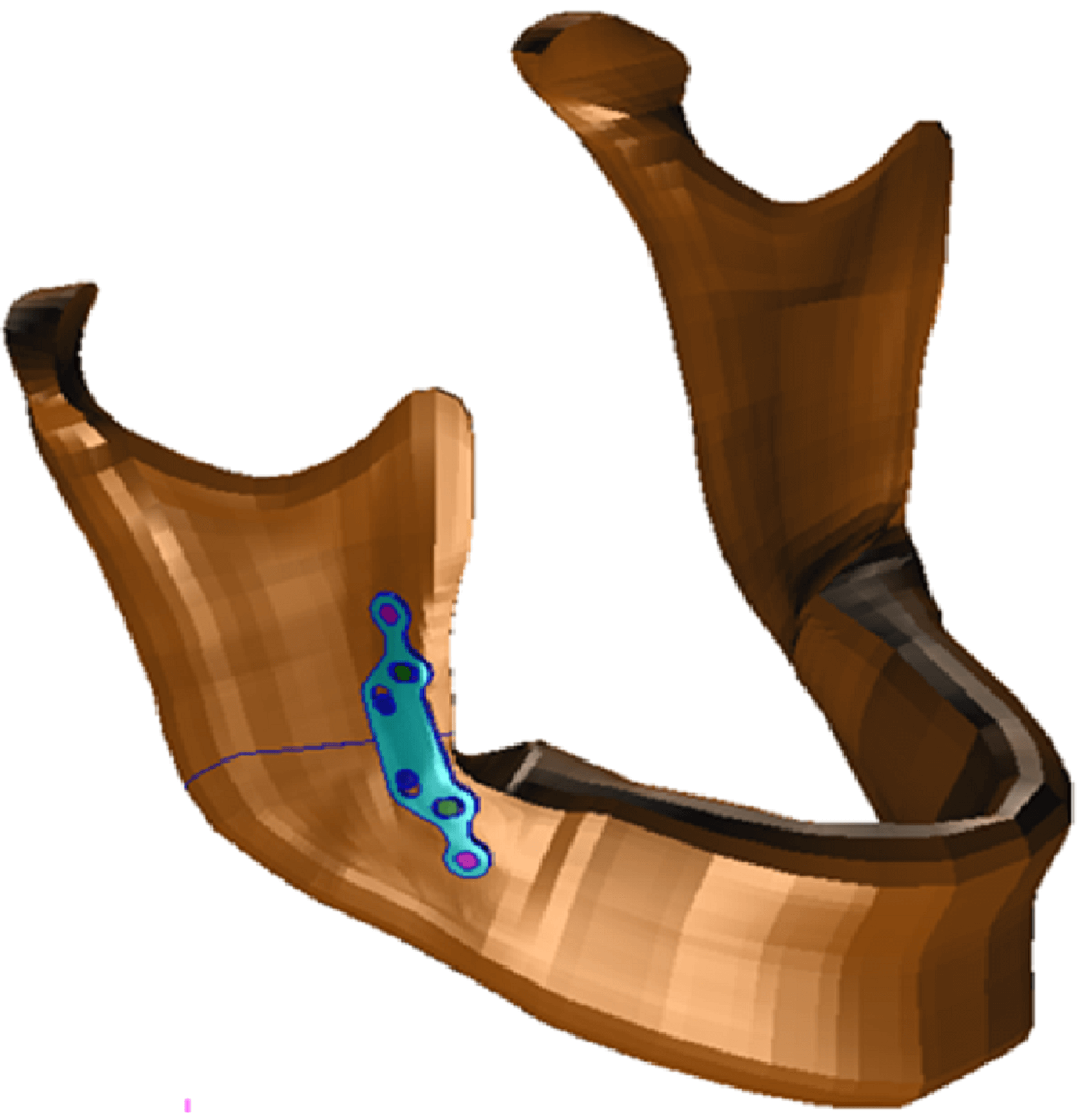 Entire mandible with mini-plate and screws
